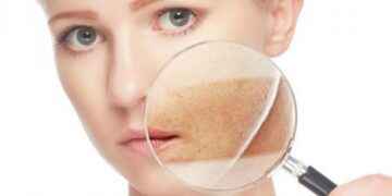 Activos vasoprotectores para calmar las pieles sensibles