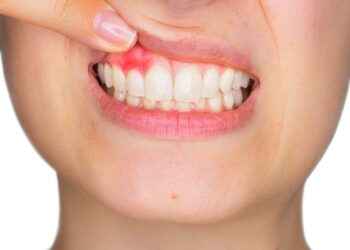Periodontitis