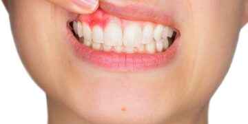 Periodontitis