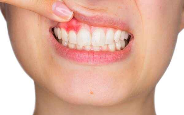 Periodontitis