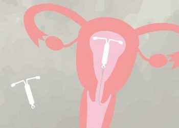 DIU: todo lo que necesitas saber sobre este método anticonceptivo