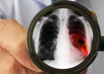 Cáncer de pulmón: un mal que no solo afecta a fumadores y va en ascenso