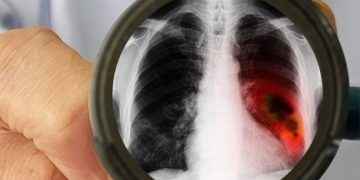 Cáncer de pulmón: un mal que no solo afecta a fumadores y va en ascenso