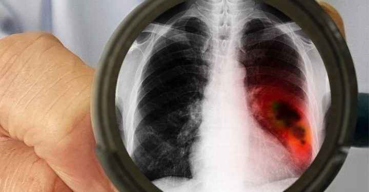 Cáncer de pulmón: un mal que no solo afecta a fumadores y va en ascenso