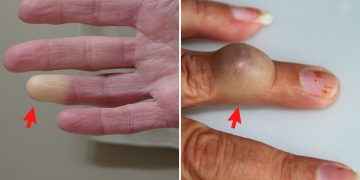 6 problemas de salud que se manifiestan en tus manos ¡NO tienes que ignorar!