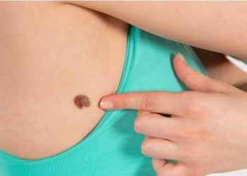 Melanoma: hay que autoexplorarse todo el cuerpo, también las uñas y los pies