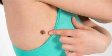 Melanoma: hay que autoexplorarse todo el cuerpo, también las uñas y los pies