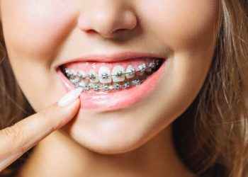 Brackets de lujo: usar brackets ¿por moda? Los riesgos de esta tendencia