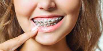 Brackets de lujo: usar brackets ¿por moda? Los riesgos de esta tendencia