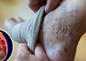 Nefropatía membranosa: cuando la hinchazón en las piernas y tobillos es señal de alerta
