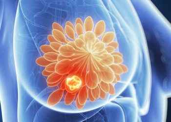 Cáncer de mama: ¿qué sigue después del diagnóstico? Tratamiento, dudas y remisión
