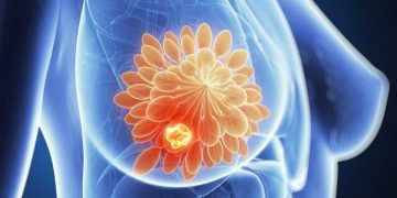 Cáncer de mama: ¿qué sigue después del diagnóstico? Tratamiento, dudas y remisión
