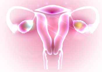 Cáncer de ovario