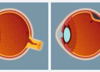 Desprendimiento de retina