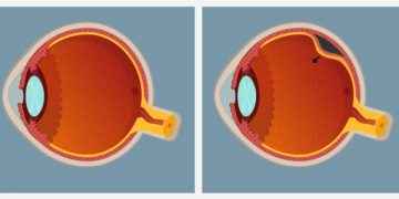Desprendimiento de retina
