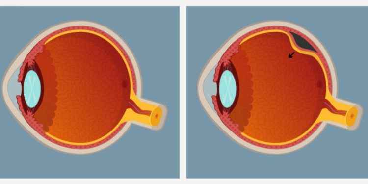 Desprendimiento de retina