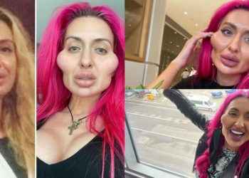 Anastasia, la modelo adicta a la pomuloplastia que busca récord