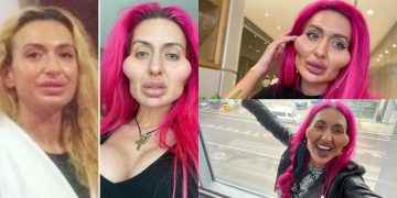 Anastasia, la modelo adicta a la pomuloplastia que busca récord