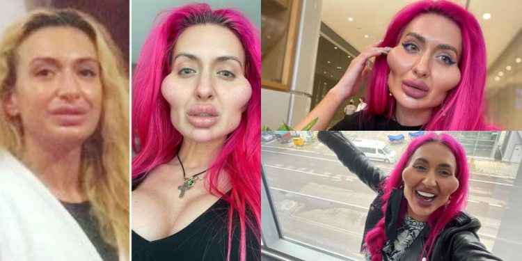 Anastasia, la modelo adicta a la pomuloplastia que busca récord