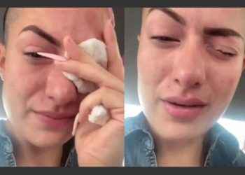 TikToker confunde gotas para los ojos y casi pierde la vista (video)