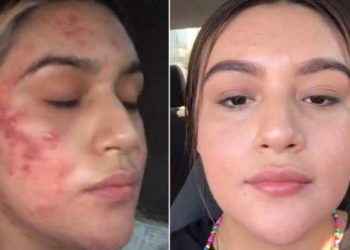 Joven muestra emotivo video de como logró superar un severo caso de acné en TikTok