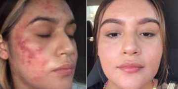 Joven muestra emotivo video de como logró superar un severo caso de acné en TikTok