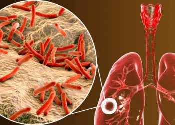 Tuberculosis