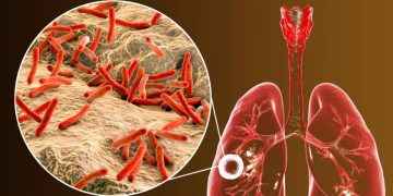 Tuberculosis