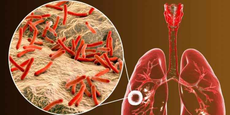 Tuberculosis