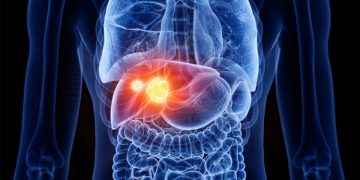 Cáncer de hígado