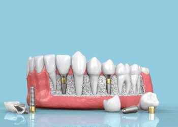 Enfermedades periimplantarias: una amenaza para los implantes dentales