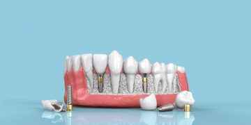 Enfermedades periimplantarias: una amenaza para los implantes dentales