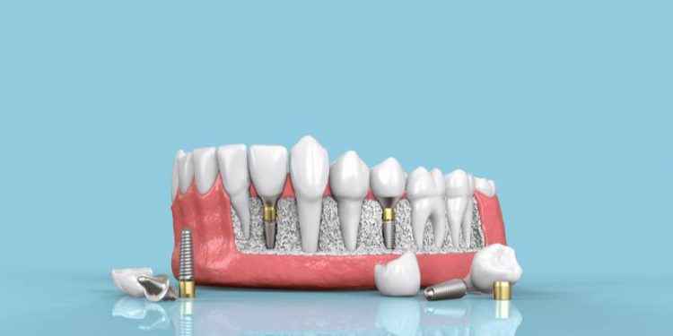 Enfermedades periimplantarias: una amenaza para los implantes dentales