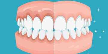 Enfermedades periodontales: cómo se previenen y tratan