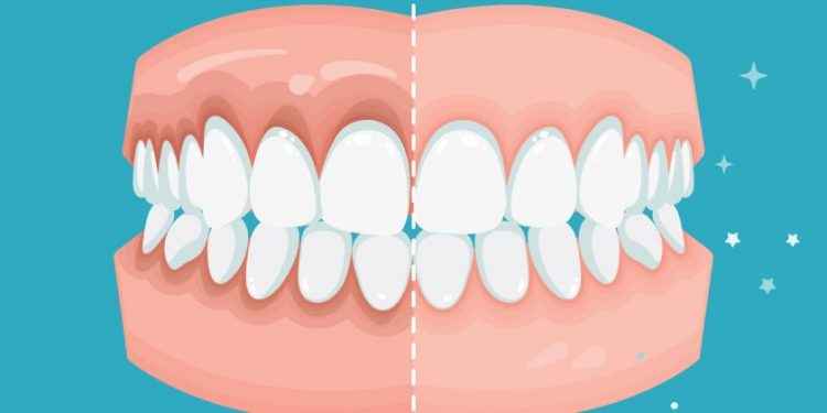 Enfermedades periodontales: cómo se previenen y tratan