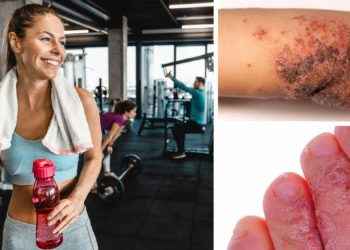 5 infecciones en la piel que puedes contraer en el gimnasio