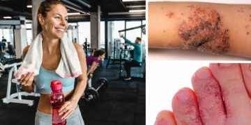 5 infecciones en la piel que puedes contraer en el gimnasio