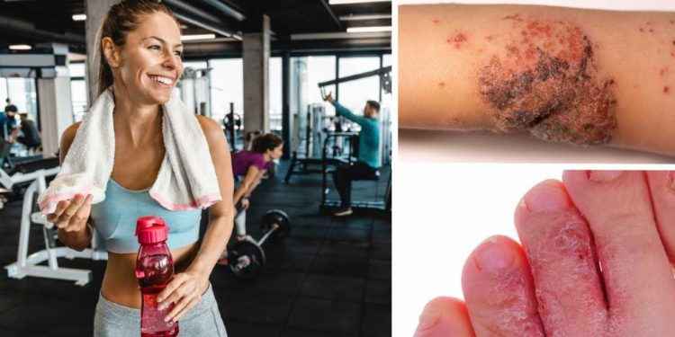 5 infecciones en la piel que puedes contraer en el gimnasio