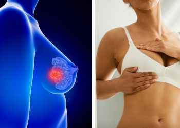 ¿Qué estudios que debe realizarse una mujer para detectar a tiempo cáncer de mama?