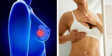 ¿Qué estudios que debe realizarse una mujer para detectar a tiempo cáncer de mama?