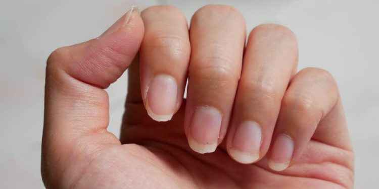 Mis uñas han cambiado de color, ¿es grave?