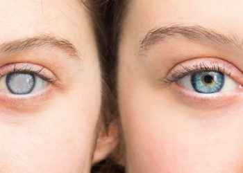 Cataratas: consejos para retrasar su aparición, según los oftalmólogos