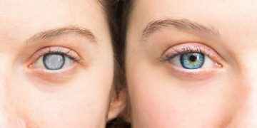 Cataratas: consejos para retrasar su aparición, según los oftalmólogos