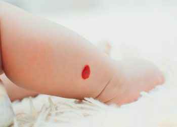 Angioma