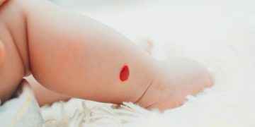 Angioma