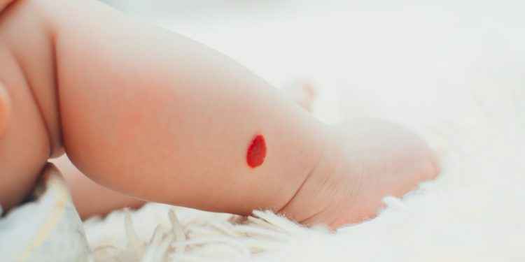 Angioma