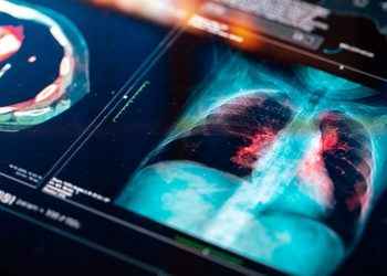 ¿Por qué el 70% del cáncer de pulmón se detectan en etapa avanzada?