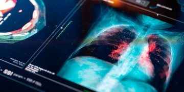¿Por qué el 70% del cáncer de pulmón se detectan en etapa avanzada?