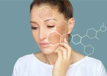 ¿Cuál es el mejor tratamiento de las manchas hormonales o melasma?