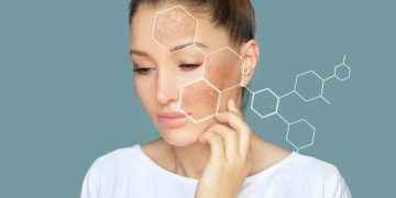 ¿Cuál es el mejor tratamiento de las manchas hormonales o melasma?